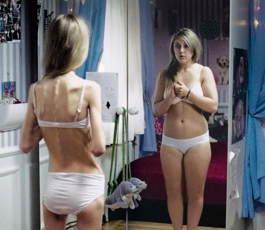 Boala secolului: anorexia