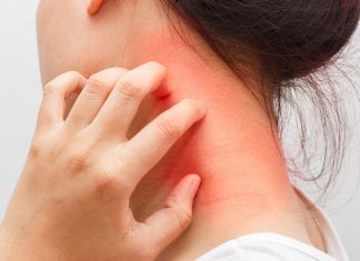 5 remedii casnice pentru dermatita