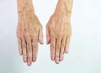 Top 5 remedii pentru petele hepatice